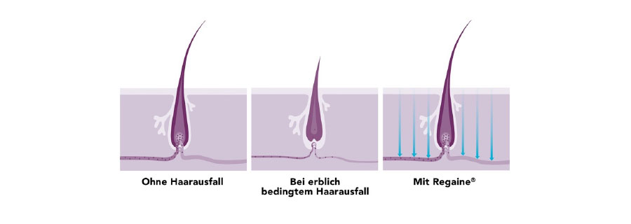 Haarausfall