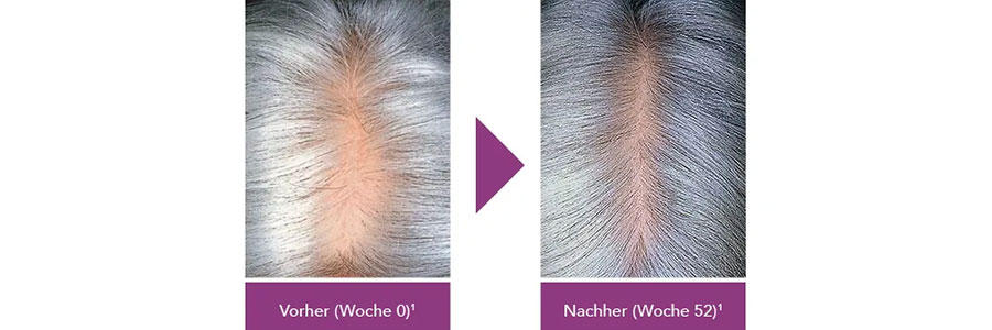 Vorher/Nachher Frauen