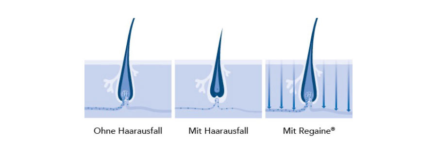 Haarausfall